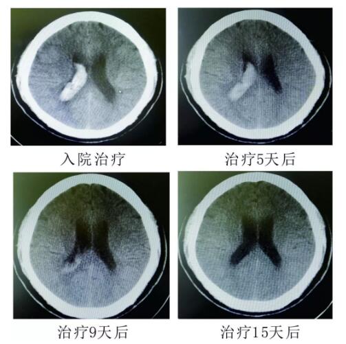 腦出血你不得不引起重視的疾病?。?！