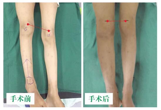 女孩墜梯右腿縮短5cm，幸得醫(yī)生及時(shí)診治恢復(fù)正常腿型