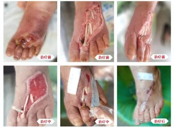 糖尿病并發(fā)癥有多可怕，及時(shí)治療糖尿病足避免截肢！