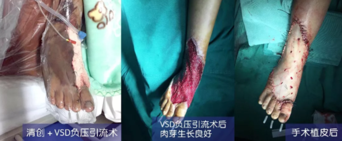 車禍猛如虎，救治如“華佗” ，手術(shù)＋康復(fù)，8歲小女孩車禍后日漸康復(fù)行走
