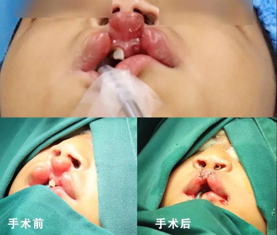 唇腭裂盡早治療消除孩子自卑心理，快樂(lè)成長(zhǎng)！
