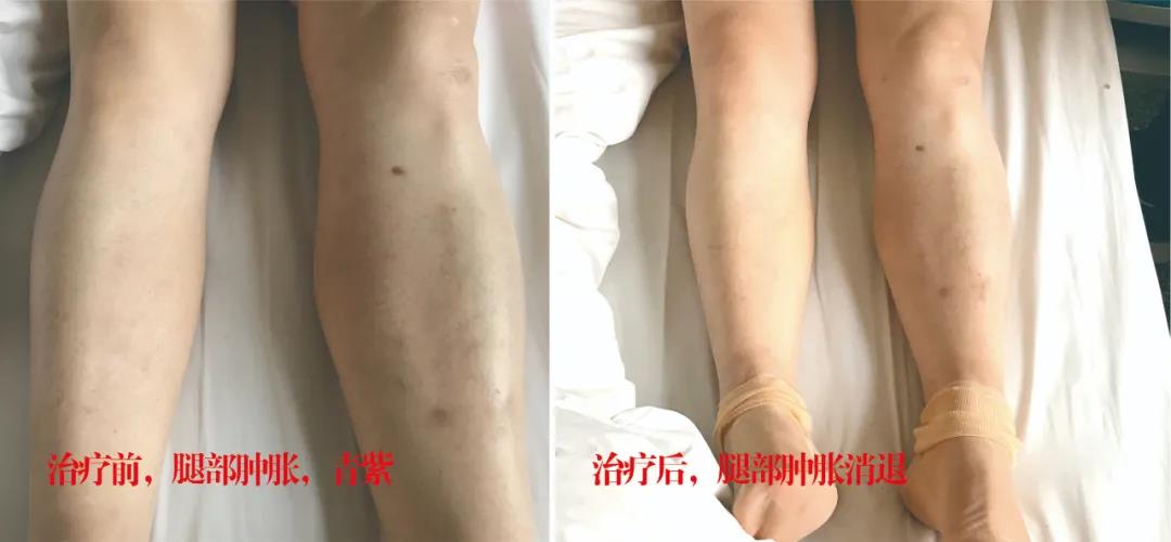 下肢靜脈血栓多年頑疾反復(fù)腫痛——疾病不容等待，早治療，早健康！