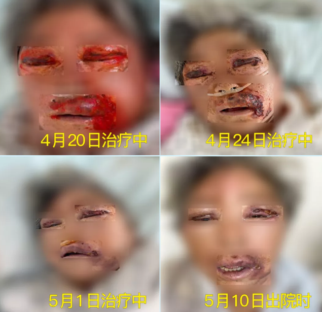 膿毒血癥（急性頜面部蜂窩組織炎）多學(xué)科聯(lián)合會(huì)診，幫助患者成功治愈！