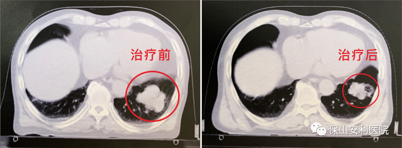 不做手術(shù)，早期肺癌也能根治！