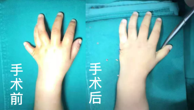 【保山安利醫(yī)院】2歲小兒手、足多指（趾）成功修復(fù)(矯正）！