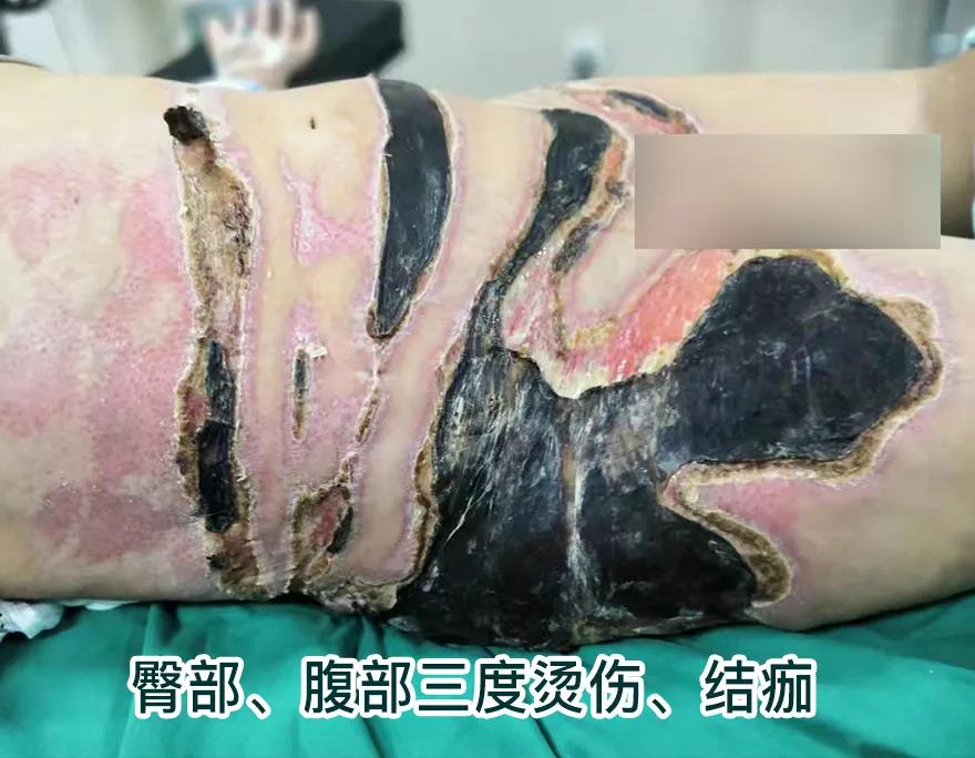 【保山安利醫(yī)院】80歲老人不慎燒傷，導(dǎo)致腹部、右側(cè)臀部大面積創(chuàng)傷，經(jīng)植皮治療創(chuàng)面逐漸愈合