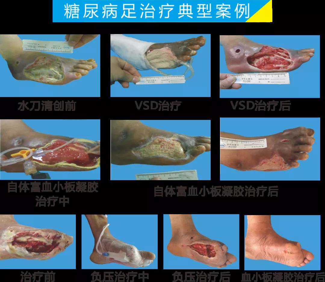 截肢、失明，甚至……，我們要做的是將糖尿病并發(fā)癥遏制在搖籃里！