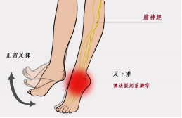 【保山安利醫(yī)院—健康科普】什么是足下垂！你了解嗎？