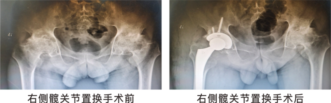 【保山安利醫(yī)院】長期飲酒導(dǎo)致雙側(cè)股骨頭壞死，髖關(guān)節(jié)置換后重獲運動功能！